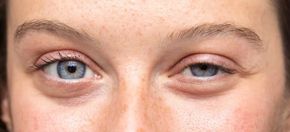 Синдром ленивого глаза